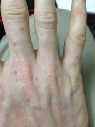 All the red dots are bug bites!