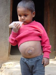 A boy with a scar from circular branding around his belly button (a common location in this area).